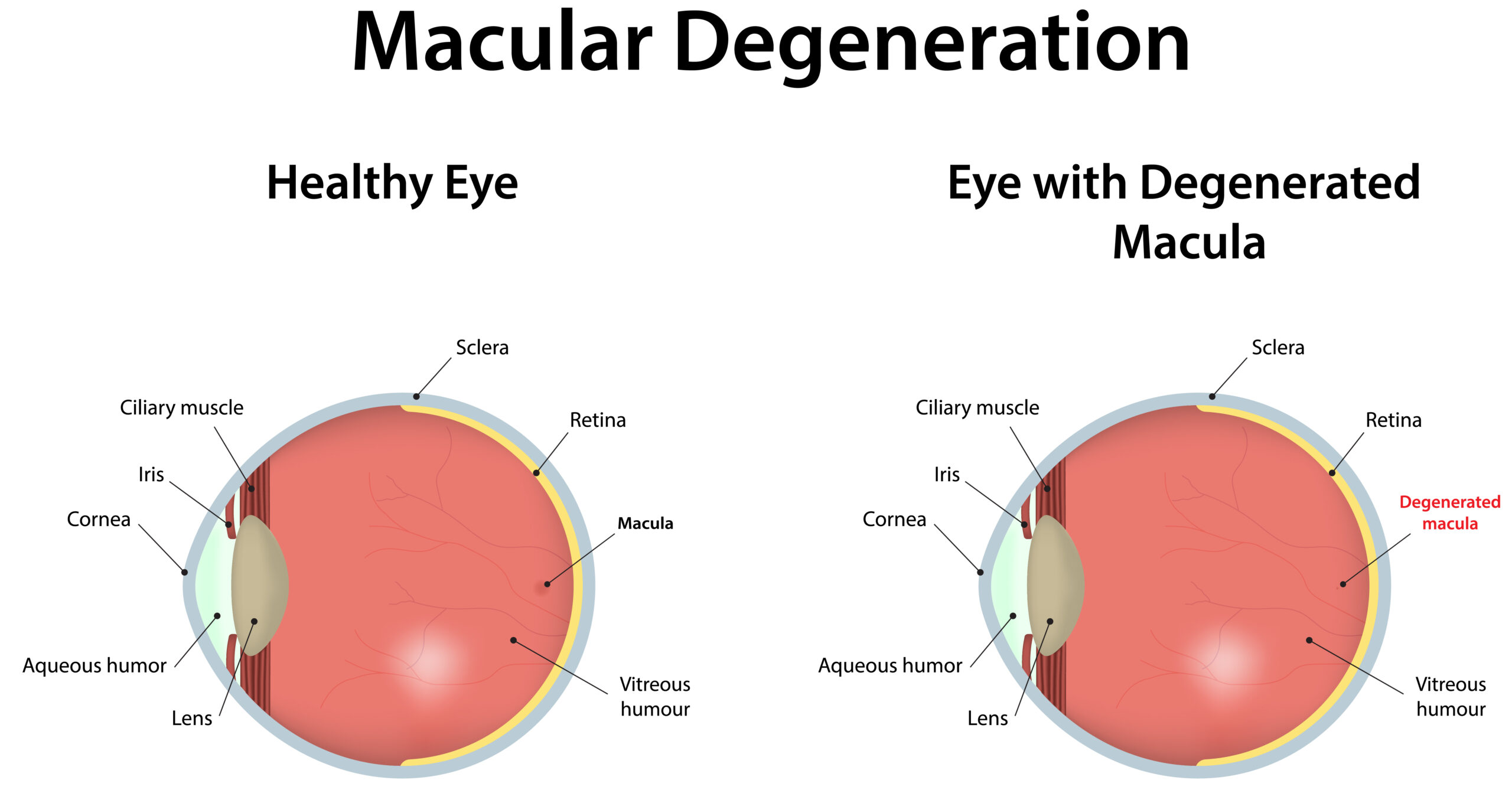 Chart illustrating healthy and degenerated macula for AMD patients