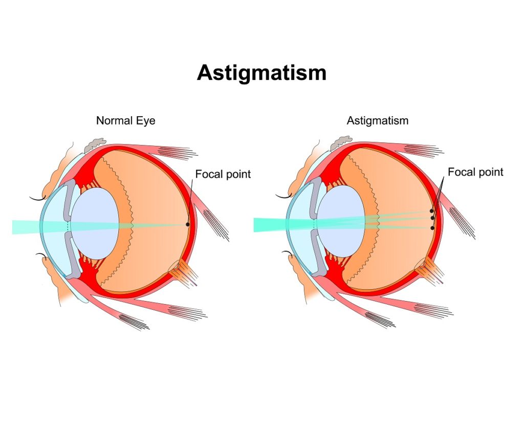 Dynamic If I Have Astigmatism Can I Get Lasik Design for Desktop Dynamic If I Have Astigmatism Can I Get Lasik Design for Desktop